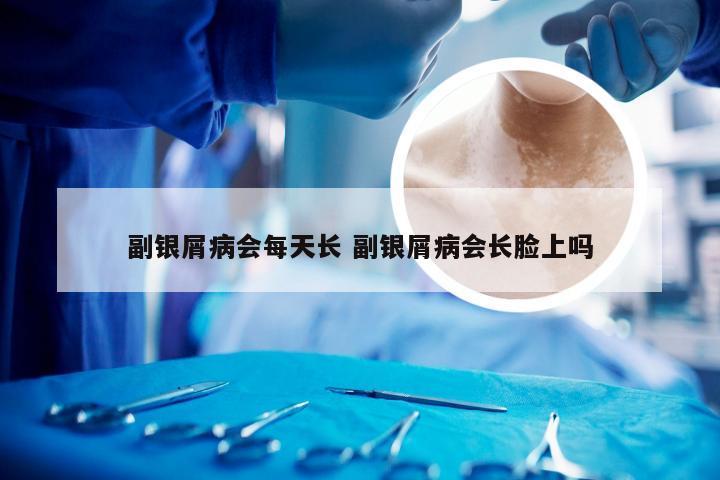 副银屑病会每天长 副银屑病会长脸上吗