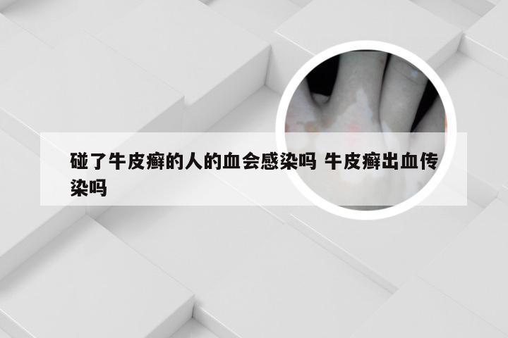 碰了牛皮癣的人的血会感染吗 牛皮癣出血传染吗