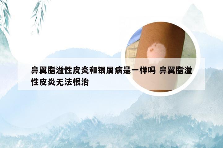 鼻翼脂溢性皮炎和银屑病是一样吗 鼻翼脂溢性皮炎无法根治