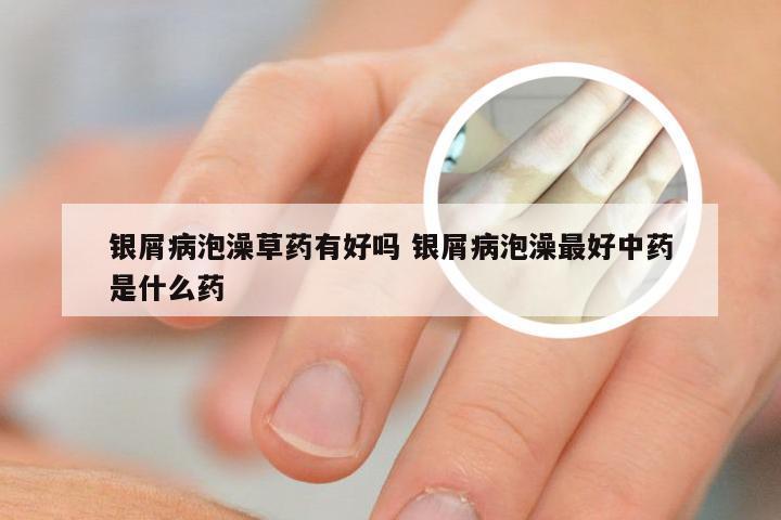 银屑病泡澡草药有好吗 银屑病泡澡最好中药是什么药