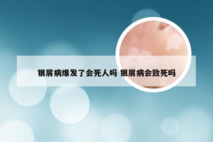 银屑病爆发了会死人吗 银屑病会致死吗