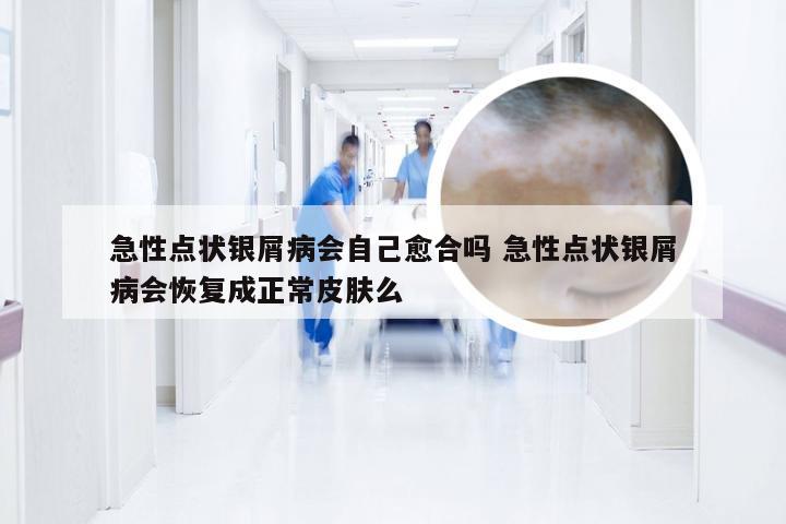 急性点状银屑病会自己愈合吗 急性点状银屑病会恢复成正常皮肤么