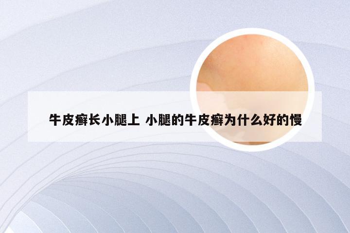 牛皮癣长小腿上 小腿的牛皮癣为什么好的慢