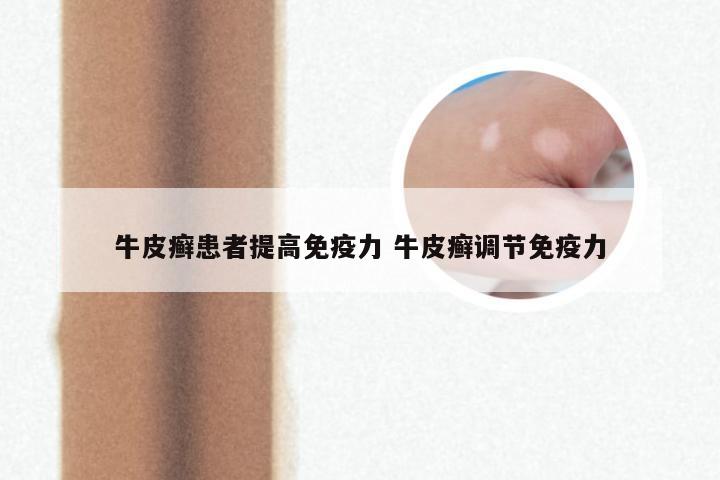 牛皮癣患者提高免疫力 牛皮癣调节免疫力