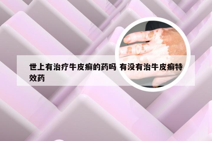 世上有治疗牛皮癣的药吗 有没有治牛皮癣特效药