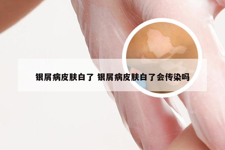 银屑病皮肤白了 银屑病皮肤白了会传染吗