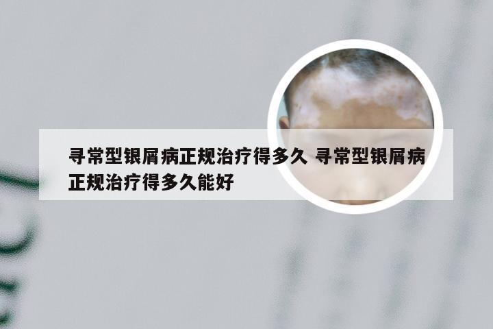 寻常型银屑病正规治疗得多久 寻常型银屑病正规治疗得多久能好