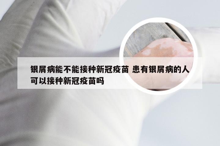 银屑病能不能接种新冠疫苗 患有银屑病的人可以接种新冠疫苗吗