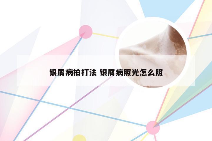 银屑病拍打法 银屑病照光怎么照