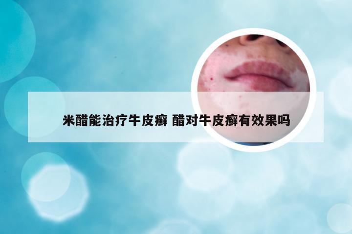 米醋能治疗牛皮癣 醋对牛皮癣有效果吗