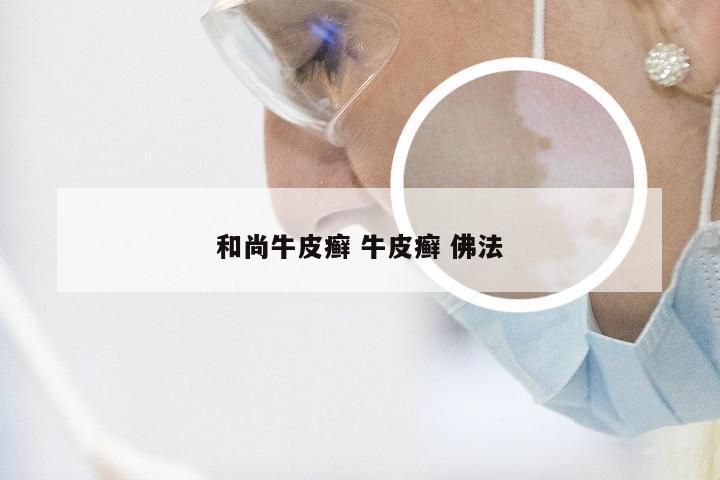 和尚牛皮癣 牛皮癣 佛法