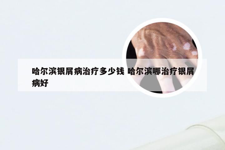 哈尔滨银屑病治疗多少钱 哈尔滨哪治疗银屑病好