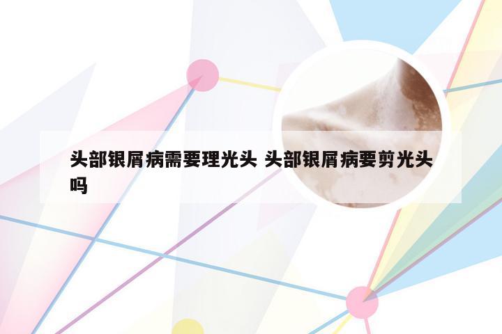 头部银屑病需要理光头 头部银屑病要剪光头吗