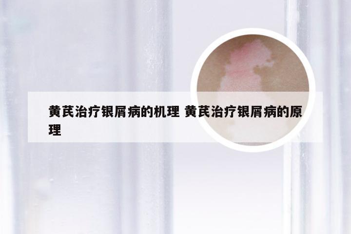 黄芪治疗银屑病的机理 黄芪治疗银屑病的原理
