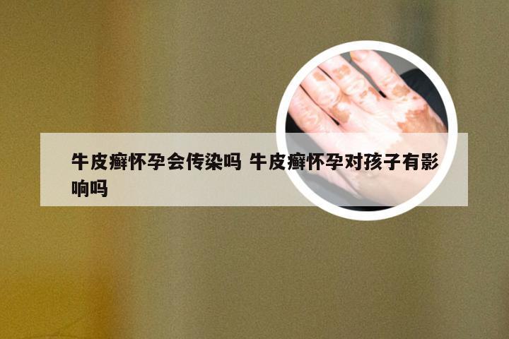 牛皮癣怀孕会传染吗 牛皮癣怀孕对孩子有影响吗
