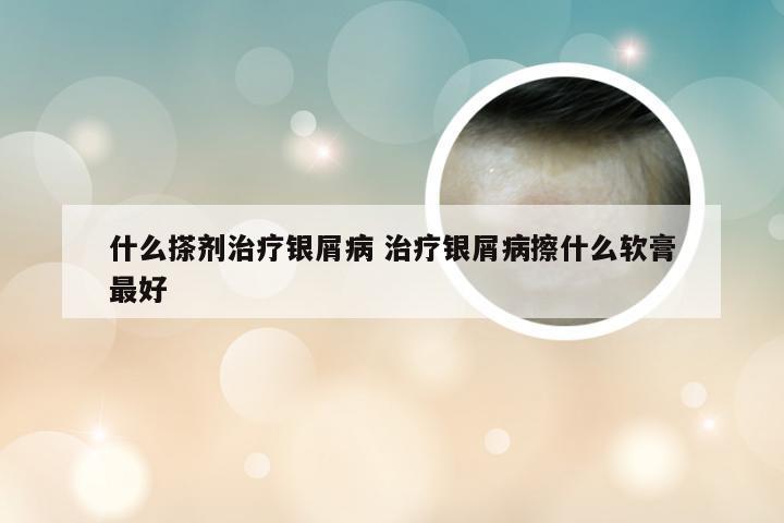 什么搽剂治疗银屑病 治疗银屑病擦什么软膏最好