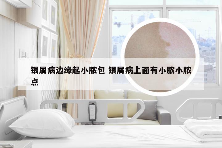银屑病边缘起小脓包 银屑病上面有小脓小脓点