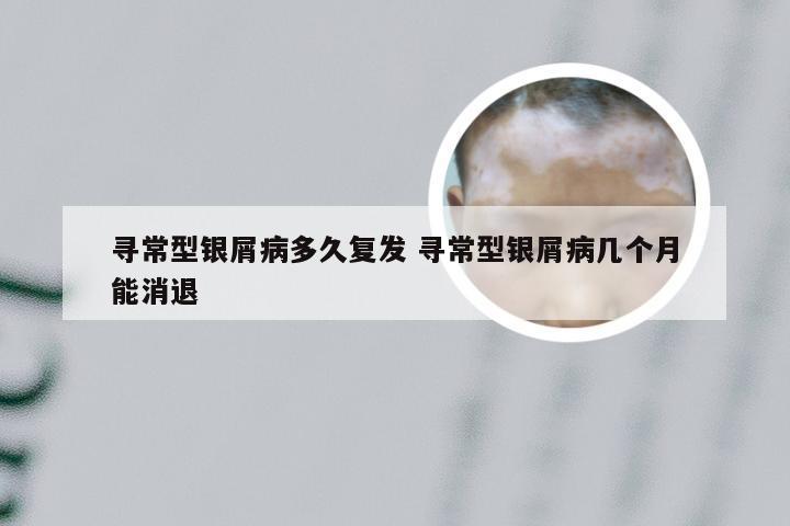 寻常型银屑病多久复发 寻常型银屑病几个月能消退