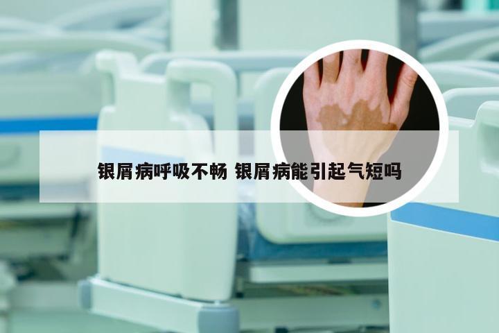 银屑病呼吸不畅 银屑病能引起气短吗