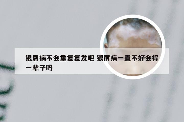 银屑病不会重复复发吧 银屑病一直不好会得一辈子吗