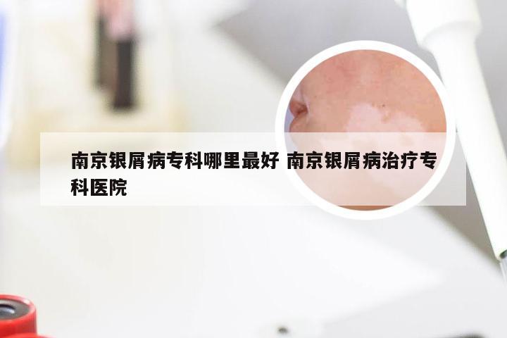 南京银屑病专科哪里最好 南京银屑病治疗专科医院