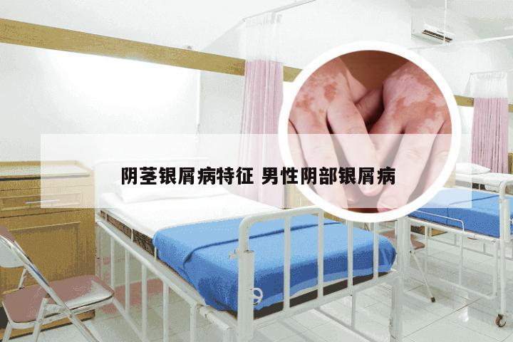 阴茎银屑病特征 男性阴部银屑病
