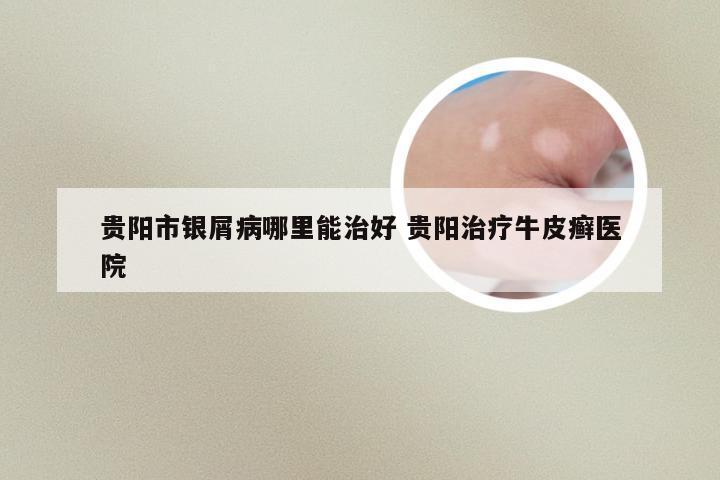 贵阳市银屑病哪里能治好 贵阳治疗牛皮癣医院