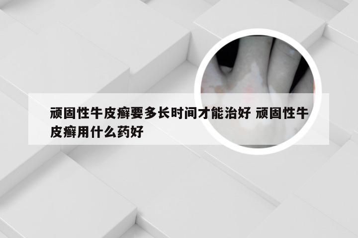 顽固性牛皮癣要多长时间才能治好 顽固性牛皮癣用什么药好