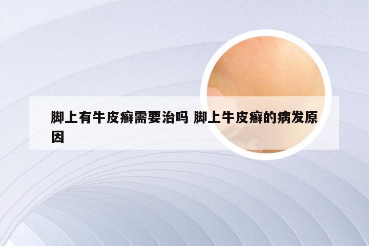 脚上有牛皮癣需要治吗 脚上牛皮癣的病发原因
