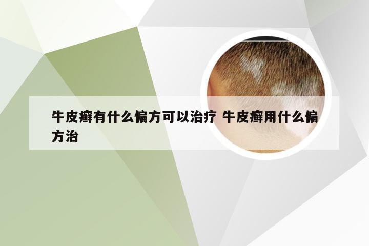 牛皮癣有什么偏方可以治疗 牛皮癣用什么偏方治