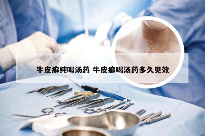 牛皮癣纯喝汤药 牛皮癣喝汤药多久见效