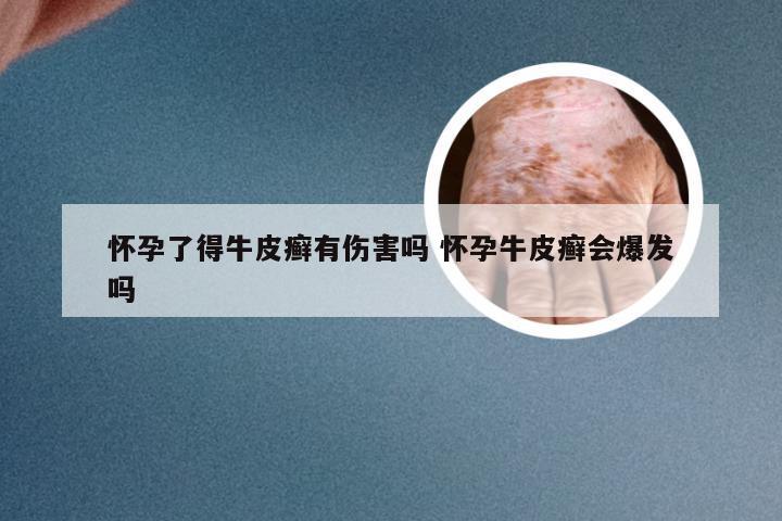 怀孕了得牛皮癣有伤害吗 怀孕牛皮癣会爆发吗