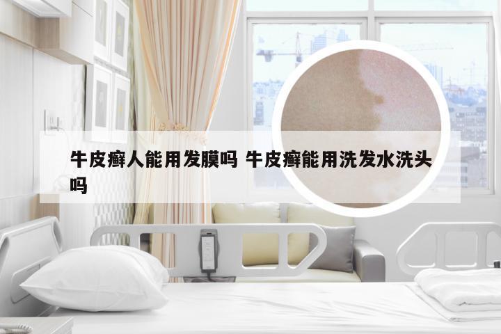 牛皮癣人能用发膜吗 牛皮癣能用洗发水洗头吗