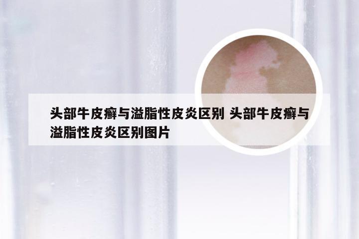 头部牛皮癣与溢脂性皮炎区别 头部牛皮癣与溢脂性皮炎区别图片