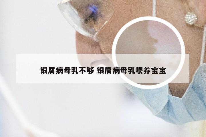 银屑病母乳不够 银屑病母乳喂养宝宝