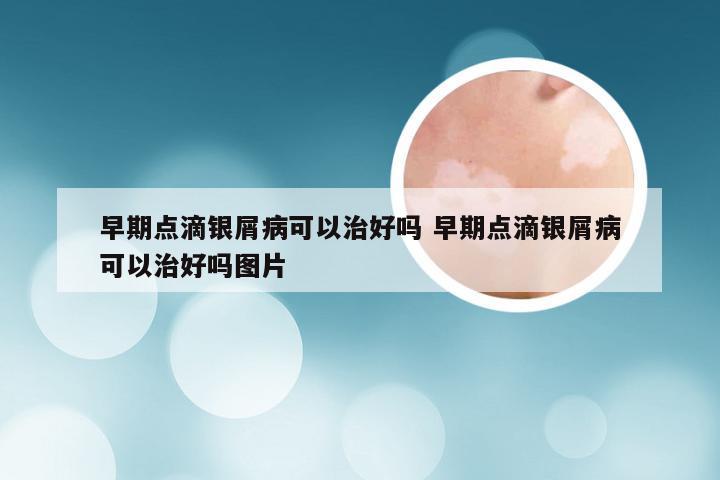 早期点滴银屑病可以治好吗 早期点滴银屑病可以治好吗图片