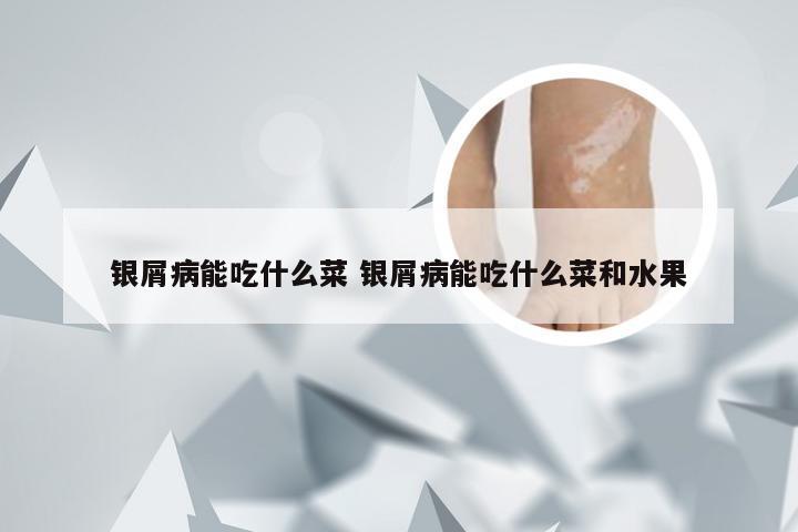 银屑病能吃什么菜 银屑病能吃什么菜和水果