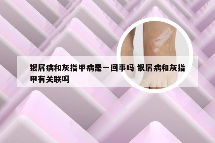 银屑病和灰指甲病是一回事吗 银屑病和灰指甲有关联吗