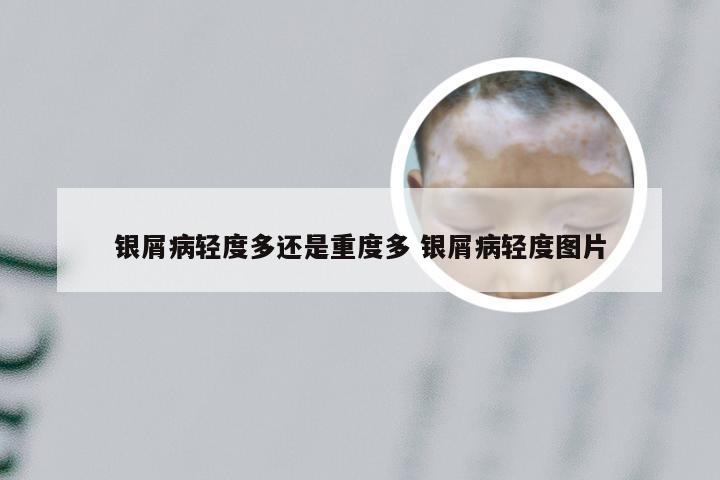 银屑病轻度多还是重度多 银屑病轻度图片