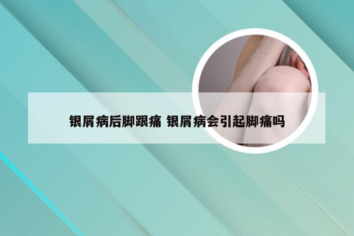 银屑病后脚跟痛 银屑病会引起脚痛吗