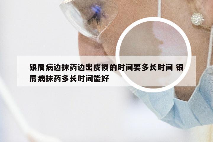银屑病边抹药边出皮损的时间要多长时间 银屑病抹药多长时间能好