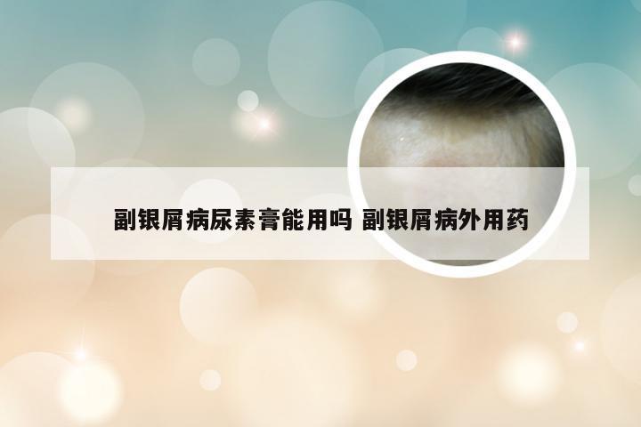 副银屑病尿素膏能用吗 副银屑病外用药
