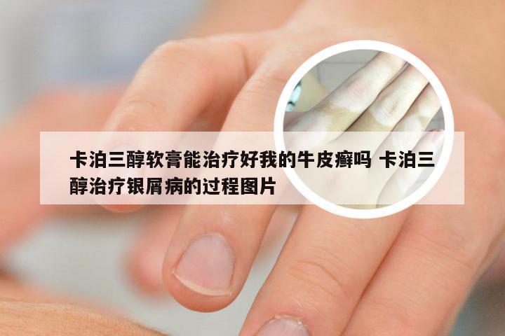 卡泊三醇软膏能治疗好我的牛皮癣吗 卡泊三醇治疗银屑病的过程图片