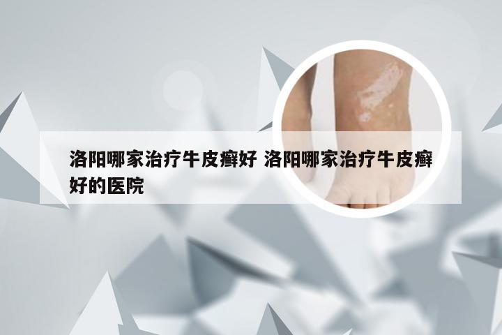 洛阳哪家治疗牛皮癣好 洛阳哪家治疗牛皮癣好的医院