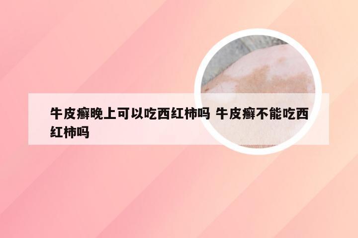牛皮癣晚上可以吃西红柿吗 牛皮癣不能吃西红柿吗