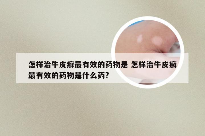怎样治牛皮癣最有效的药物是 怎样治牛皮癣最有效的药物是什么药?