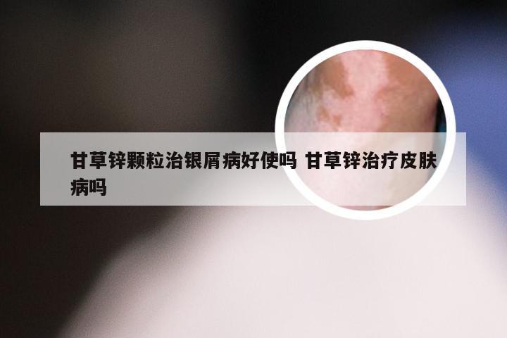 甘草锌颗粒治银屑病好使吗 甘草锌治疗皮肤病吗