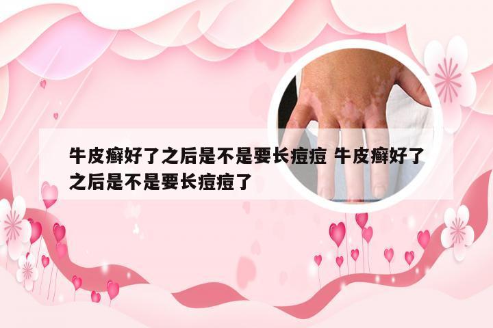 牛皮癣好了之后是不是要长痘痘 牛皮癣好了之后是不是要长痘痘了