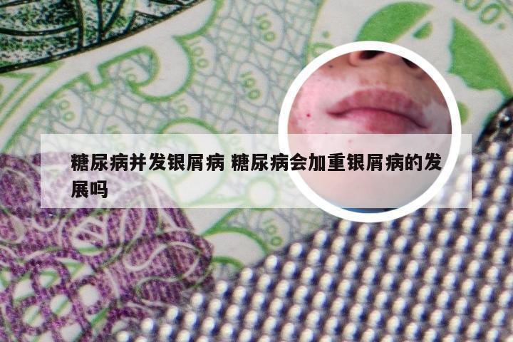 糖尿病并发银屑病 糖尿病会加重银屑病的发展吗