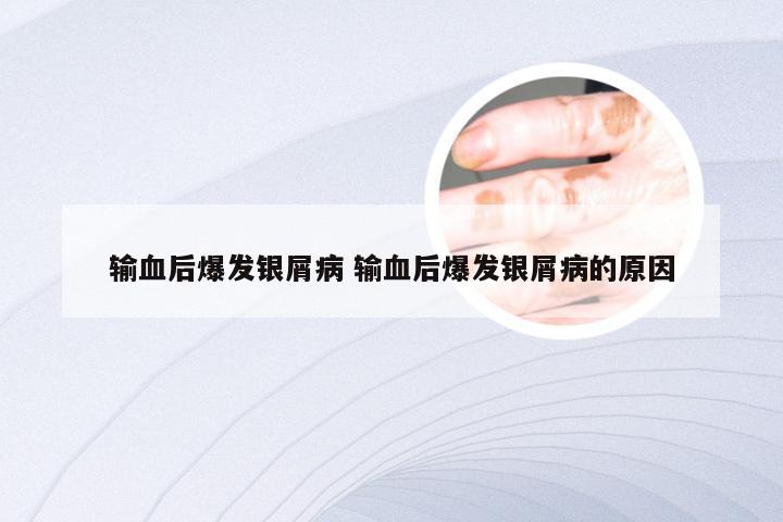 输血后爆发银屑病 输血后爆发银屑病的原因